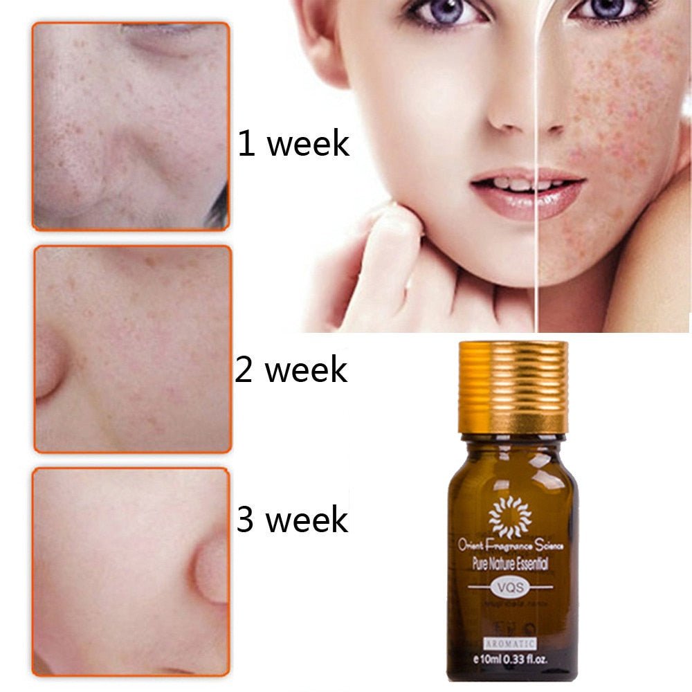 Dredge Meridian Skin Care Natural Pure Removal Acne Stretch Marks Scar Removal Essence oil - Body Bliss Essentials