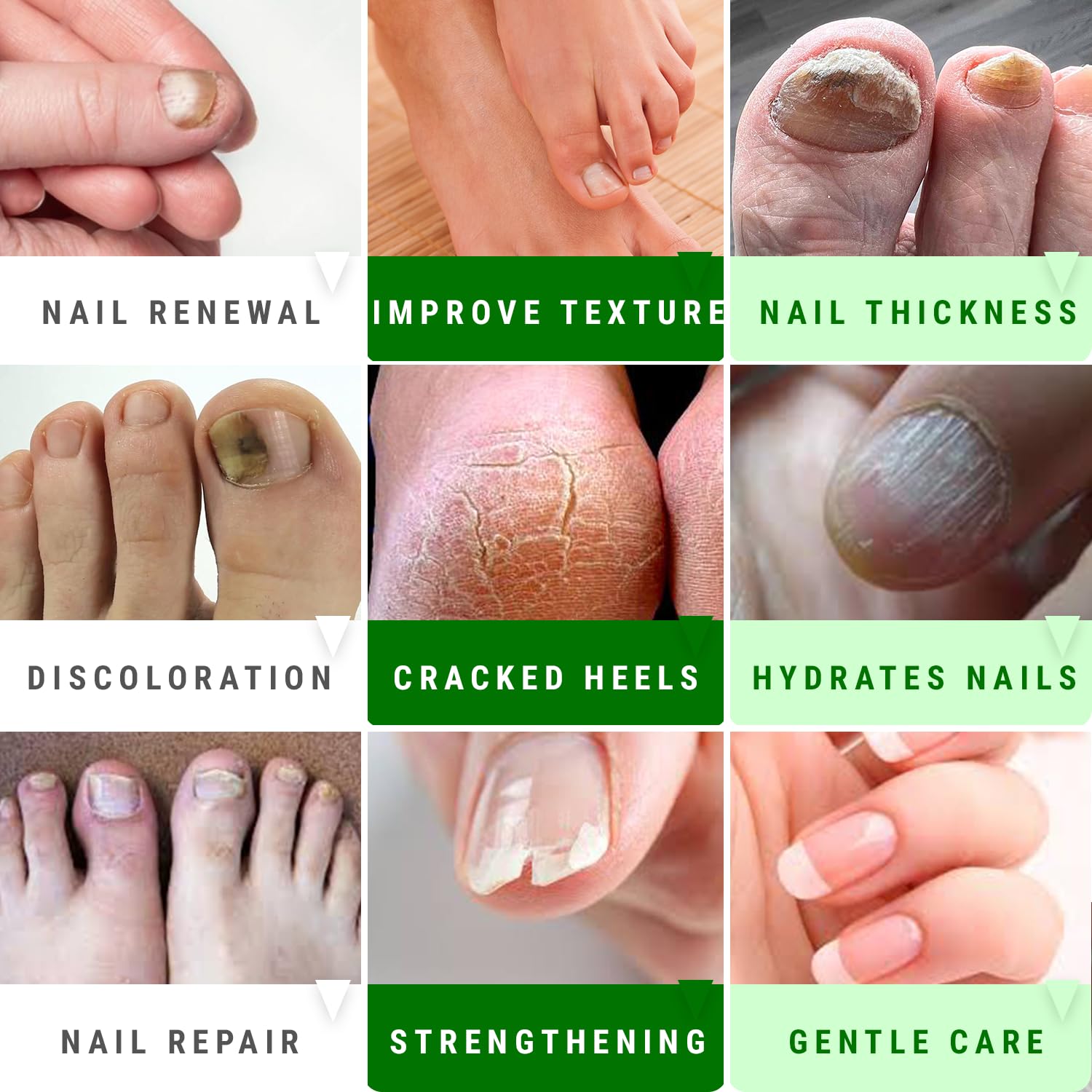Urea Nail Gel - Softens Cracked Heel Calluses & Thick Toenails